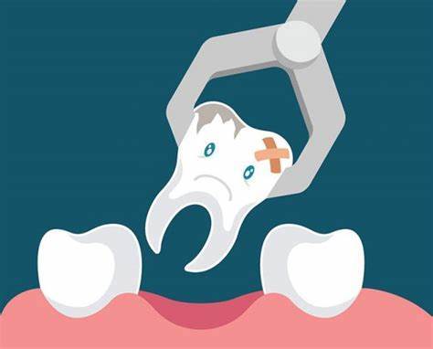 拔牙患者福利来了:拔牙前,后需要注意什么,口腔专业医师为你详细解说