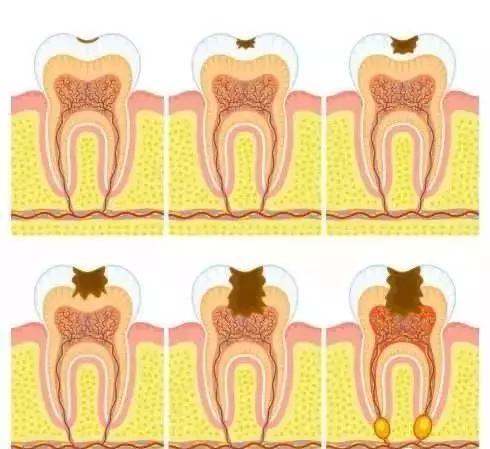 窝沟龋的发展过程(图片来自网络)