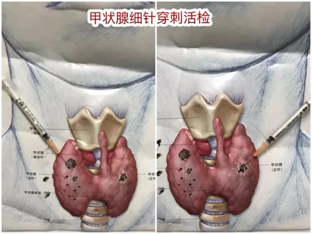 个问题:既然彩超已经判断甲状腺结节为恶性,为什么还要做甲状腺穿刺呢