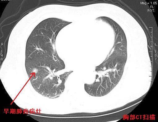 对于早期肺癌,以及肺部的其他病变的检查,目前 公认最为敏感的影像学
