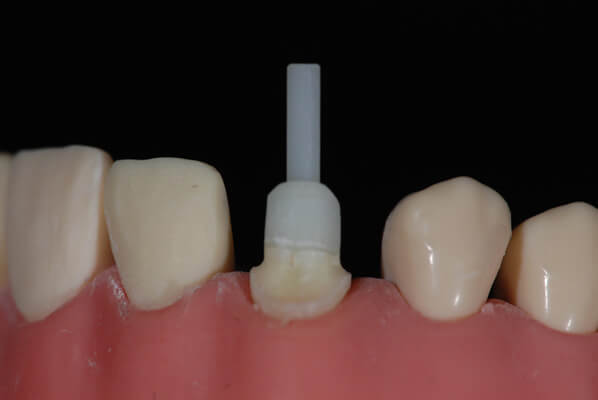 根管治疗后 纤维桩延长和加固患牙