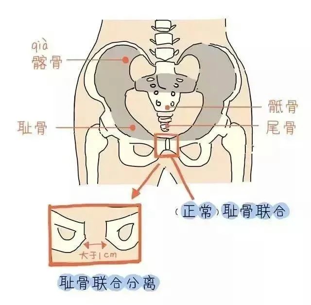 骨盆变宽倾斜疼痛产后妈妈如何恢复完美骨盆