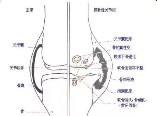 膝关节滑膜炎的分类与表现