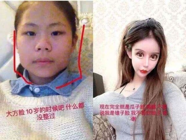 13岁女孩嫌自己丑,整容60次花费100多万,网友:还不如不整?