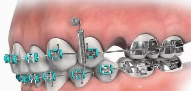 采用上颌活动矫治器,附有平面导板和牙合垫,从收官一个牙开始逐个调磨