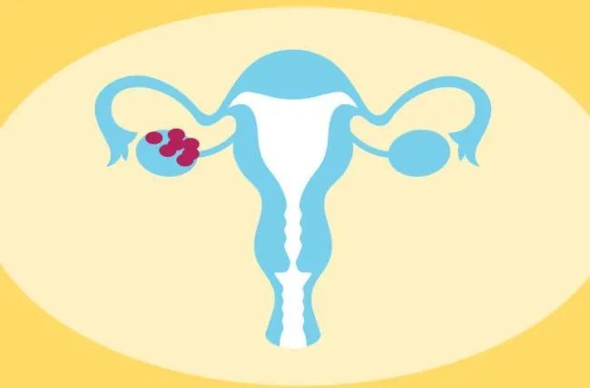 肠道菌群:多囊卵巢综合征治疗的新希望?