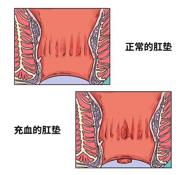 而肛门 却只能靠着出口那一圈肛垫硬撑 当肛垫充血肿胀 痔疮就成型了