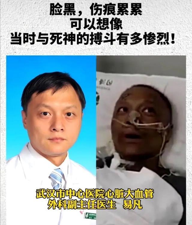 两名医生感染新冠肺炎,被救回后脸部完全变黑,原因找到了