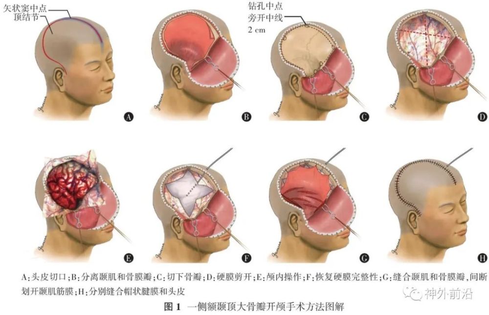 科室见面会|专访天坛医院刘佰运:大骨瓣减压手术会造成创伤后的脑积水