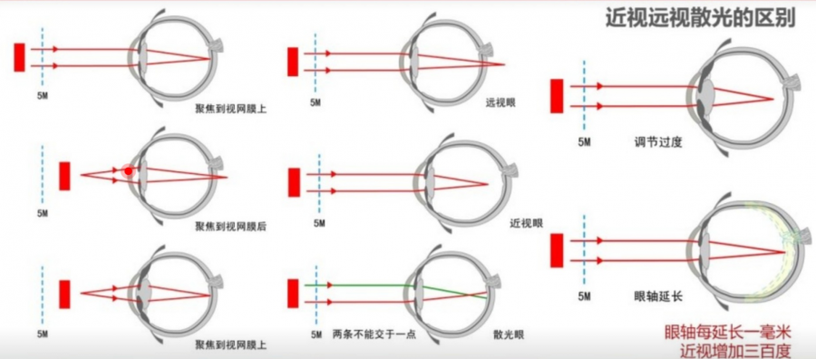 近视,远视,散光的区别是什么?