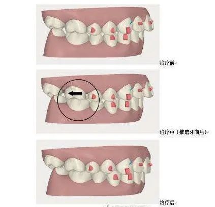 成都：牙齿矫正后复发的原因是什么？