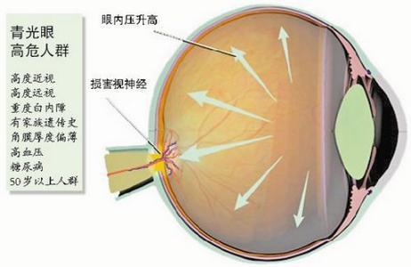 青光眼是一组具有特征性视神经损害和视野缺损的眼病,可能会损害视