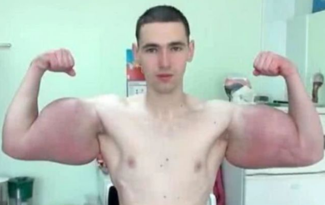 那个被叫“大力水手”的俄罗斯男子，往胳膊里注水增肌引起轰动，如今成怎样