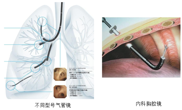 孙加源支气管镜在肺癌诊疗中的规范应用和创新