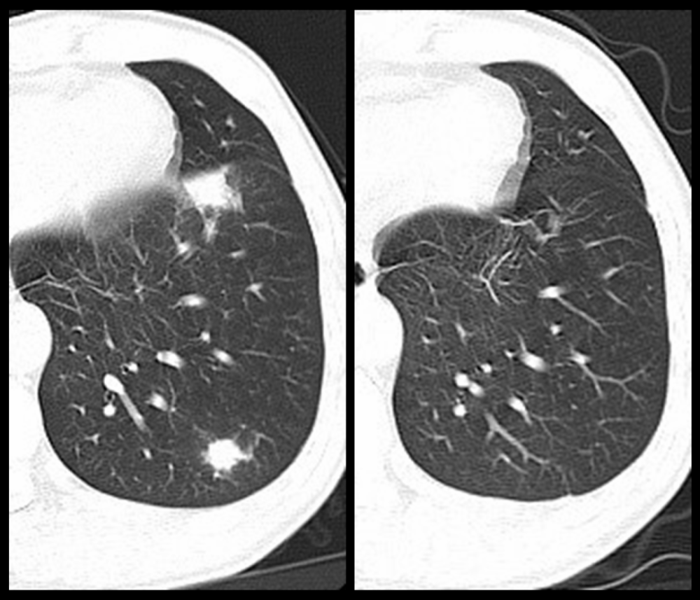 肺结节就是肺癌吗特征性影像了解一下