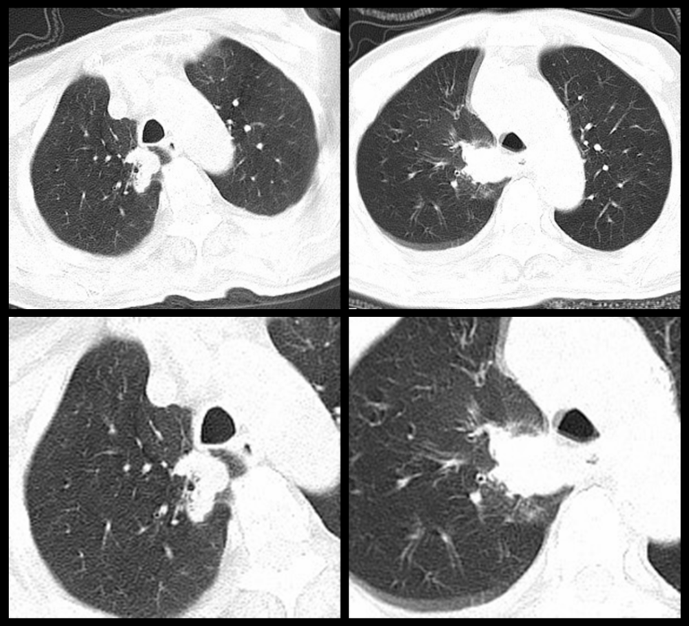 肺结节就是肺癌吗?特征性影像了解一下