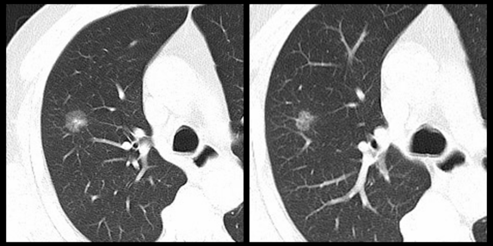 肺结节就是肺癌吗特征性影像了解一下
