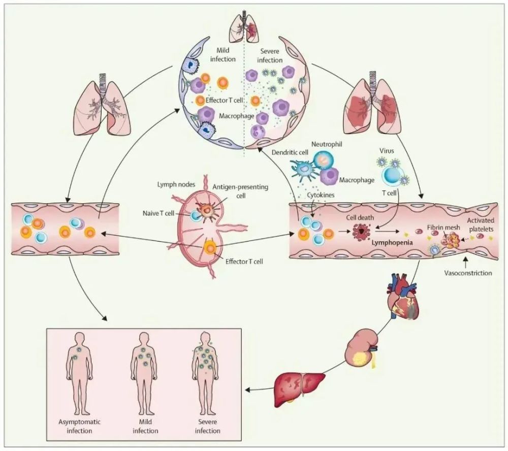 在轻症sars-cov-2感染者中,肺部的巨噬细胞能够激活炎症反应并吞噬