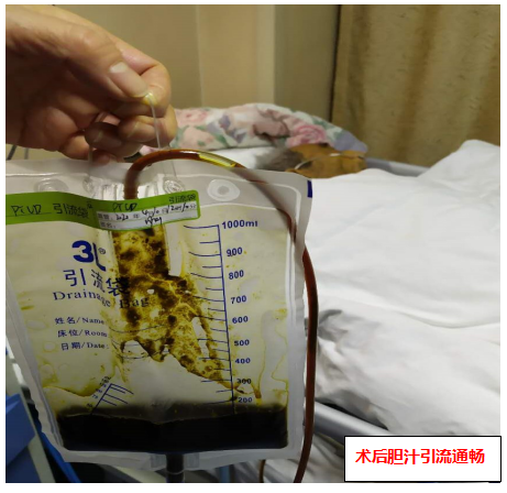 "ug-ptbd(超声引导下经皮经肝穿刺胆管置管引流术)的优势!1.