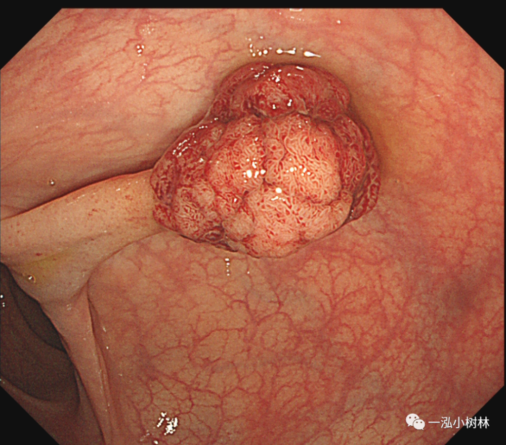 常见的大肠癌癌前病变-结肠息肉