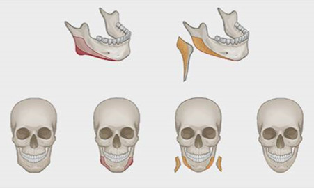 下颌角手术的特点