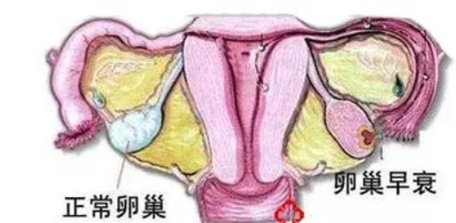 女人卵巢老化怎么办,怎么样才能卵巢调理的好?