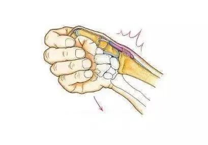 肌腱滑膜炎,常见的症状就是手腕用力或向小手指那边偏斜时会出现疼痛