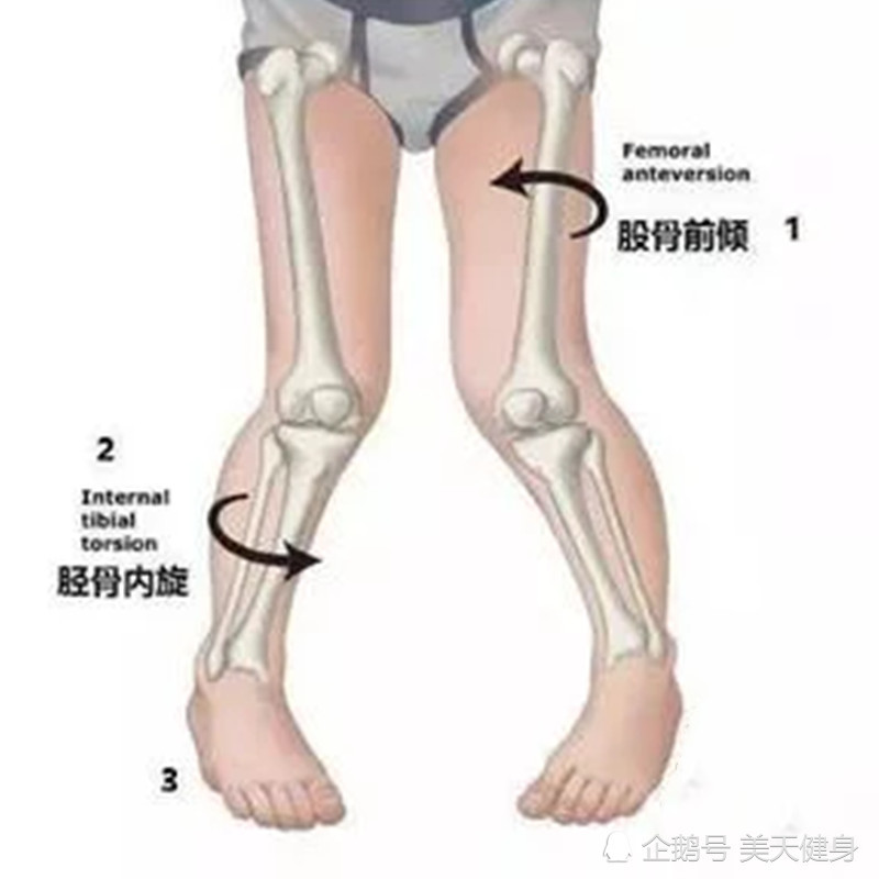 2,内八字站立或走路