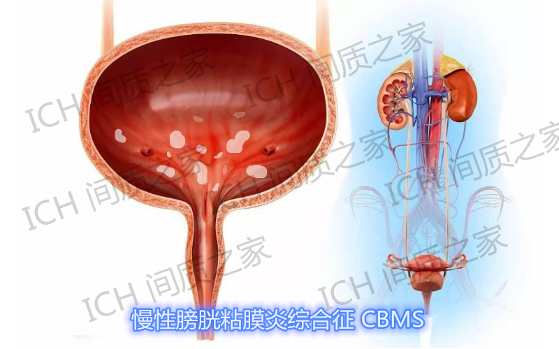 反复尿路感染,尿频,尿意强烈与膀胱粘膜白斑有关_腾讯新闻