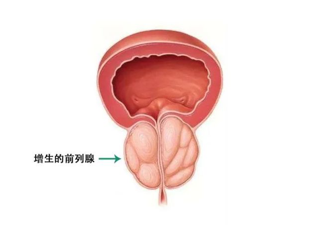 图片来源:google 增生的腺体压迫尿道导致排尿阻力增加,进而出现