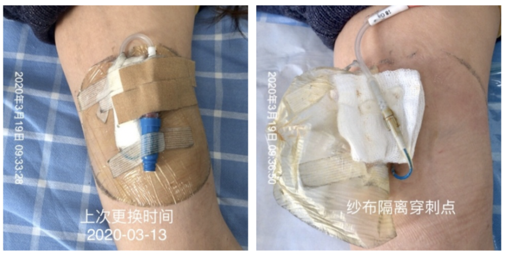 冲管时发现picc导管破了!患者还等着化疗,该咋办?
