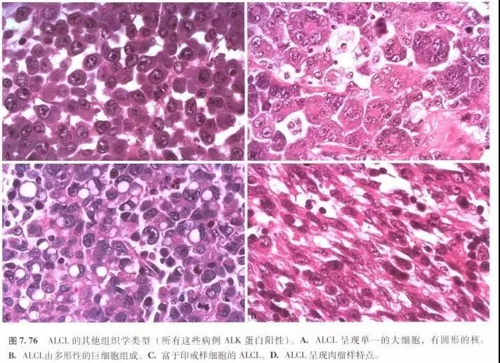 间变性大细胞淋巴瘤,alk阳性