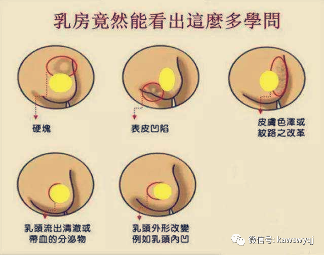 乳腺癌是女性深恶痛绝的癌症!如何通过"摸一摸"发现乳腺肿瘤?