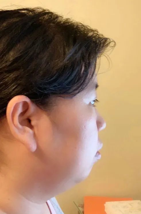 孩子习惯用嘴巴呼吸,一定会变丑吗?