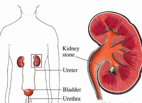 人是怎么患上肾结石的