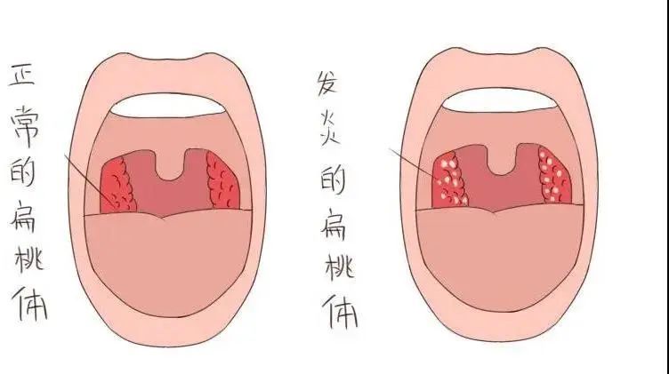 扁桃体的陷窝上出现许多小脓栓,严重的会布满脓苔.