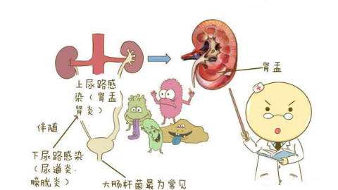 泌尿系统感染是怎么回事?