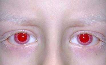 有红眼的白化病人