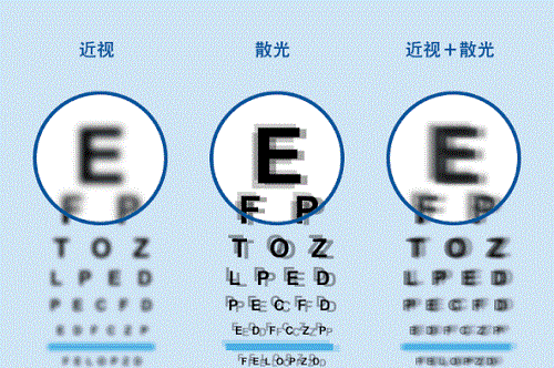 做完近视手术,我的散光怎么办?