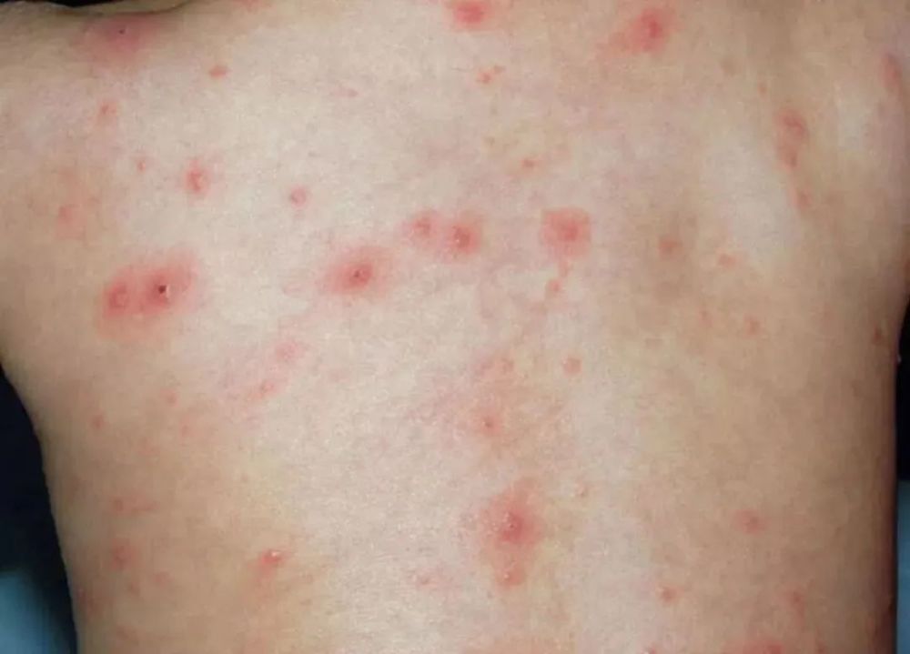 水痘是属于急性传染病, 婴幼儿和 学龄前儿童中很常见.