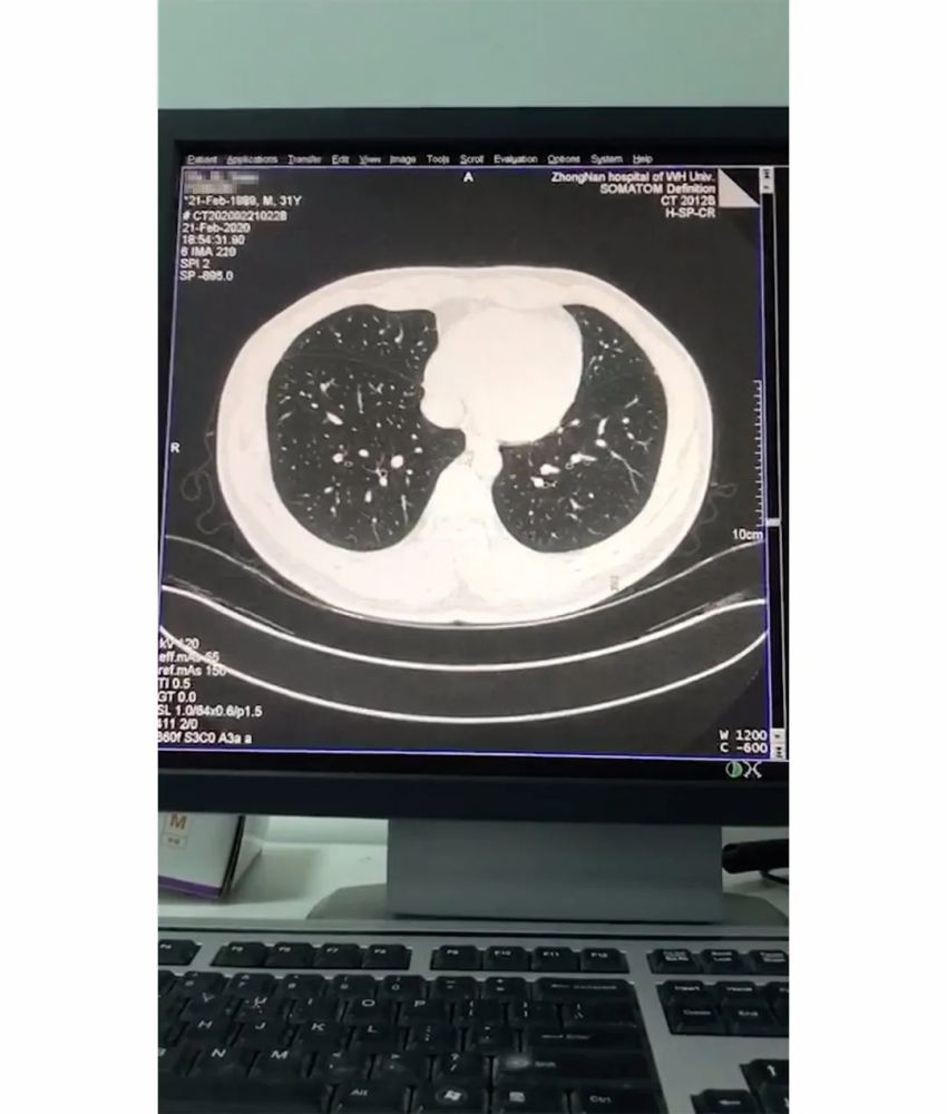 3月8日,怕自己得病,去做了ct,医生说没有感染,并且是一个光滑健康的肺