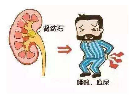保守治疗肾结石的患者,平时用这个小方法,结石排得更快