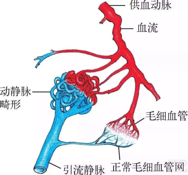 动静脉血管畸形示意图 打开腾讯                     @网络图片 脑