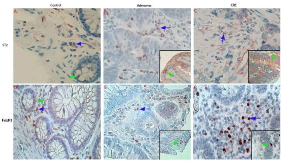 正常结直肠,腺瘤与crc组织中st2阳性细胞和foxp3阳性treg的免疫组化