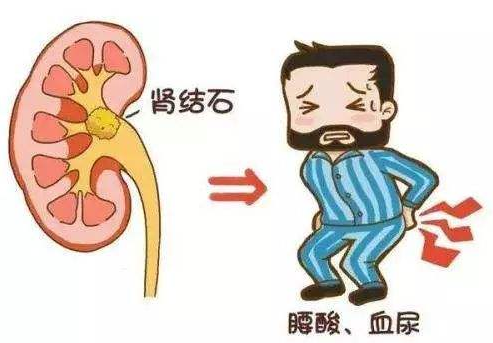 这三类人容易患上肾结石!看看自己符合吗?