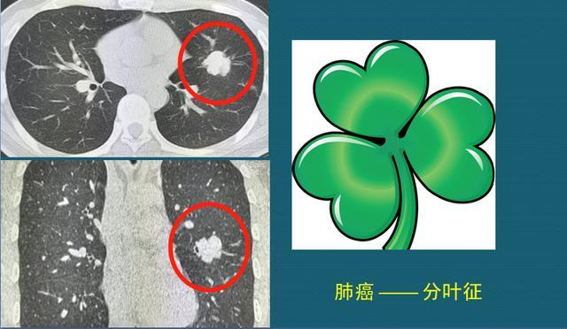 从ct片上看肺癌结节有4个常见表现医生教你入门学ct