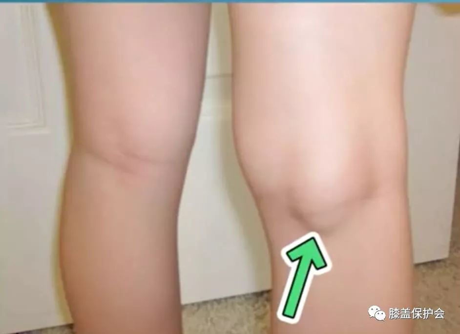 膝盖退化的这三种征兆,用肉眼就能看出!