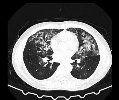 两位患者肺部影像"毛玻璃"样,竟是"84"惹的祸