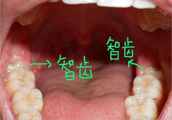 古人也长智齿,他们从来不拔,为什么现代人一定要拔掉智齿呢?