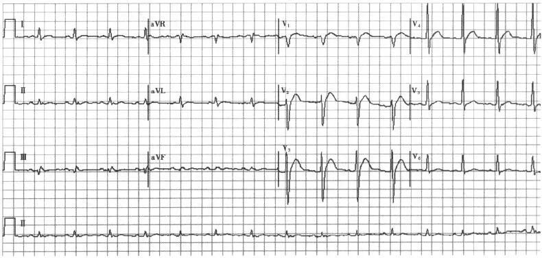 高钙血症,心电图有迹可循
